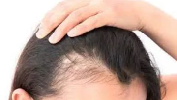 জেনে নিন চুল পড়ার কারণগুলো