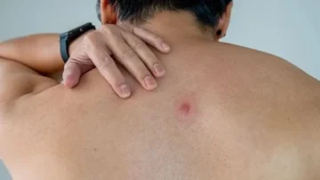 বারবার ফোড়া হওয়া কিসের লক্ষণ? হলে কী করনীয়?